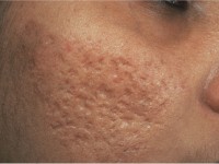 CysticAcne